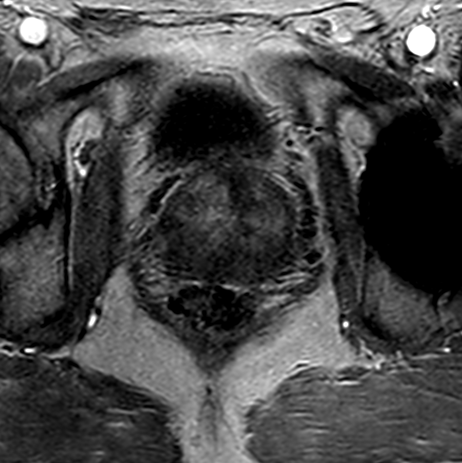 Axial dynamic 3D T1w FFE - Permeability 44 sec