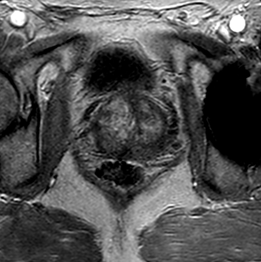 Axial dynamic 3D T1w FFE - Permeability 54 sec