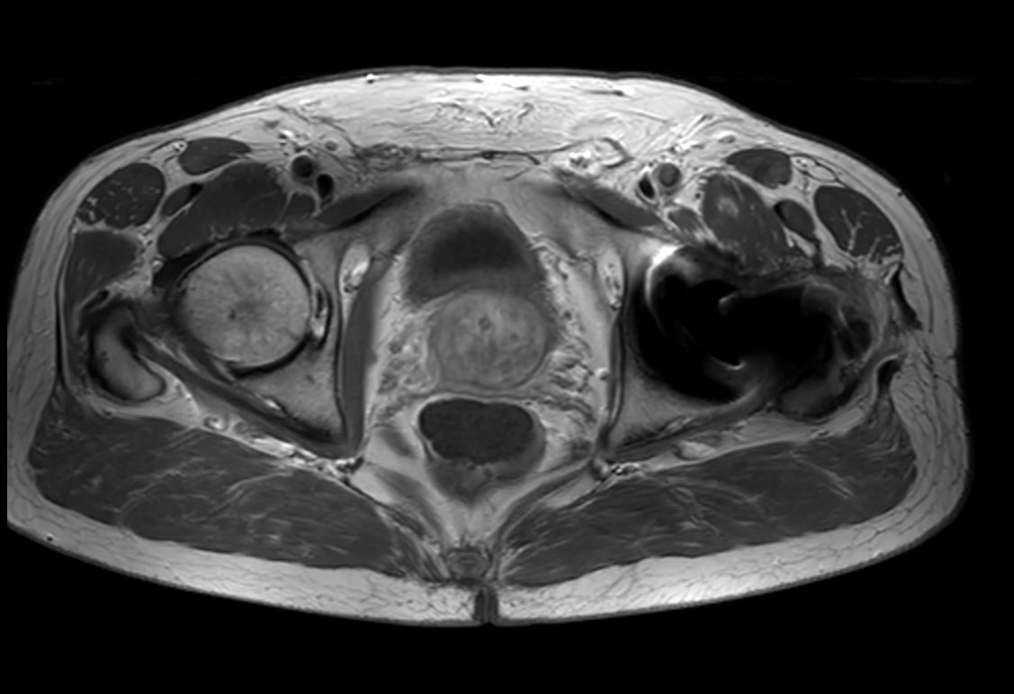 Axial T1w TSE + gado