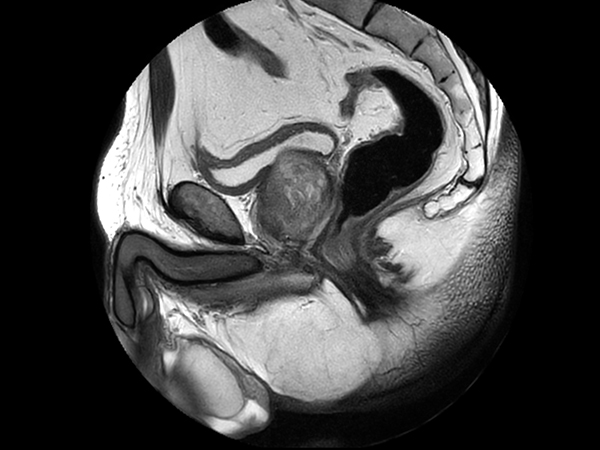 Sagittal T2w TSE MultiVane XD