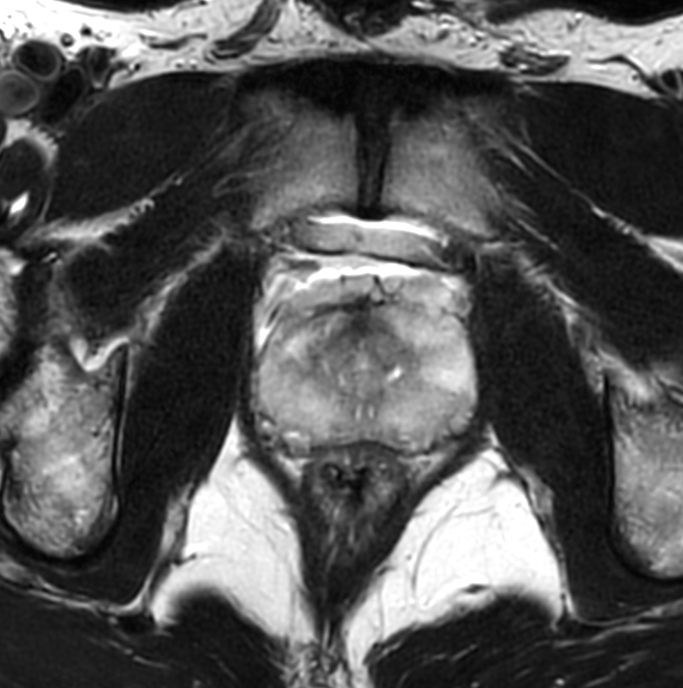 Axial T2w TSE - dS ZOOM
