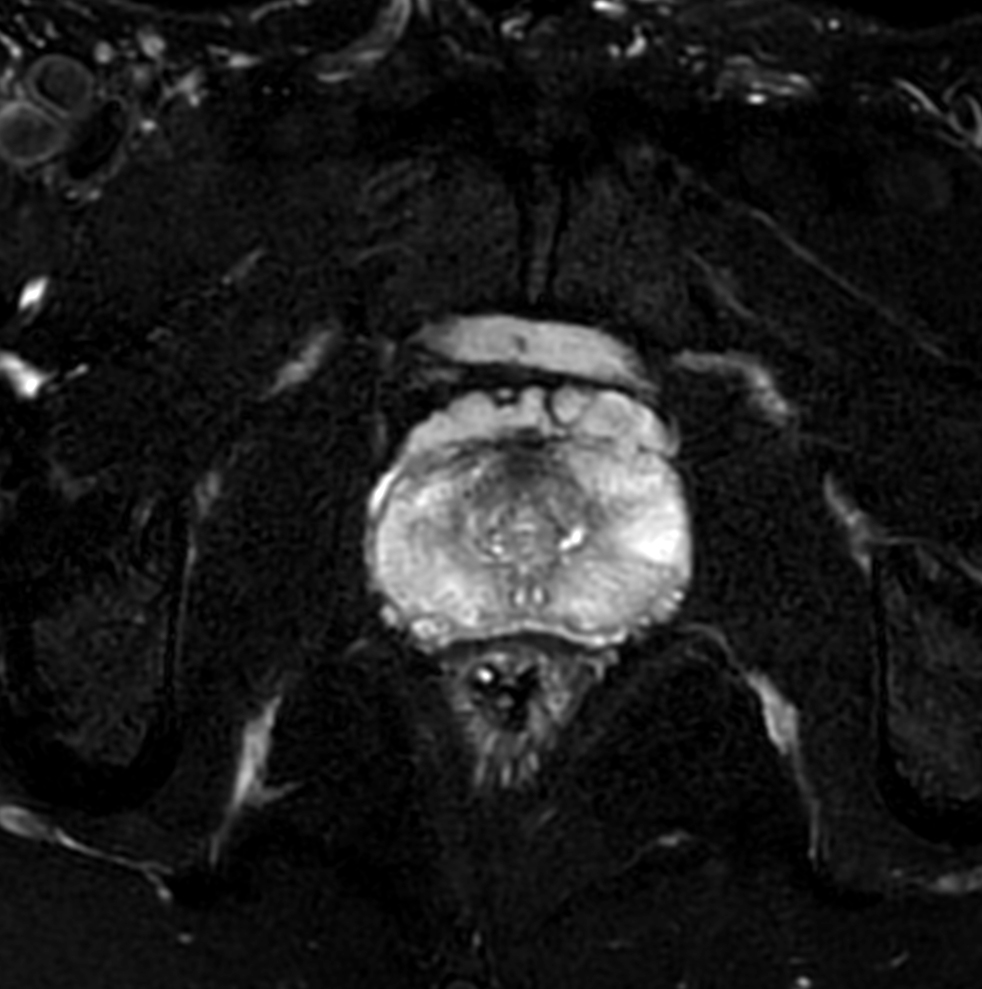Axial T2w SPAIR - dS ZOOM