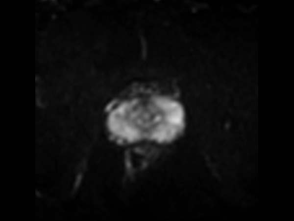 Axial DWI (b100)