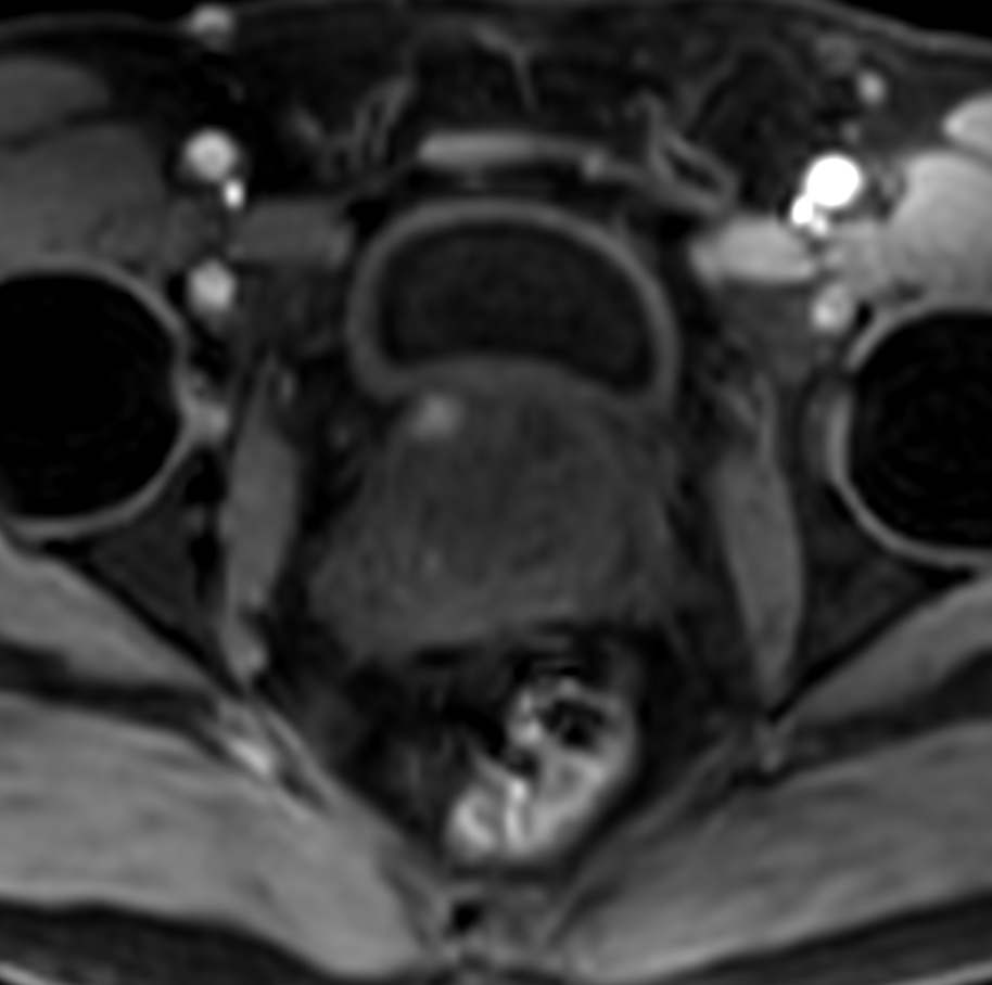 Axial dynamic T1w mDIXON XD - Permeability 34 sec