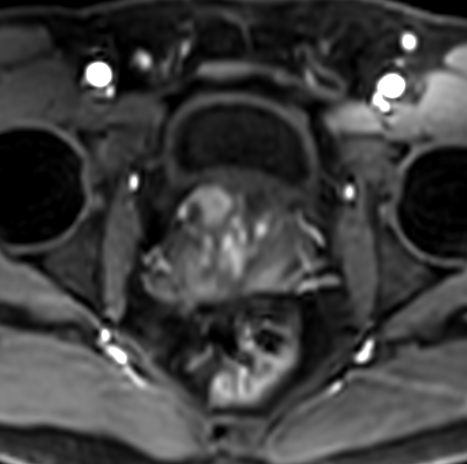 Axial dynamic T1w mDIXON XD - Permeability 53 sec