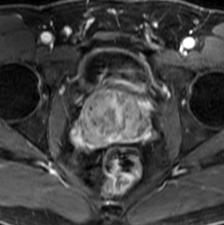 Axial dynamic T1w mDIXON XD with Compressed SENSE