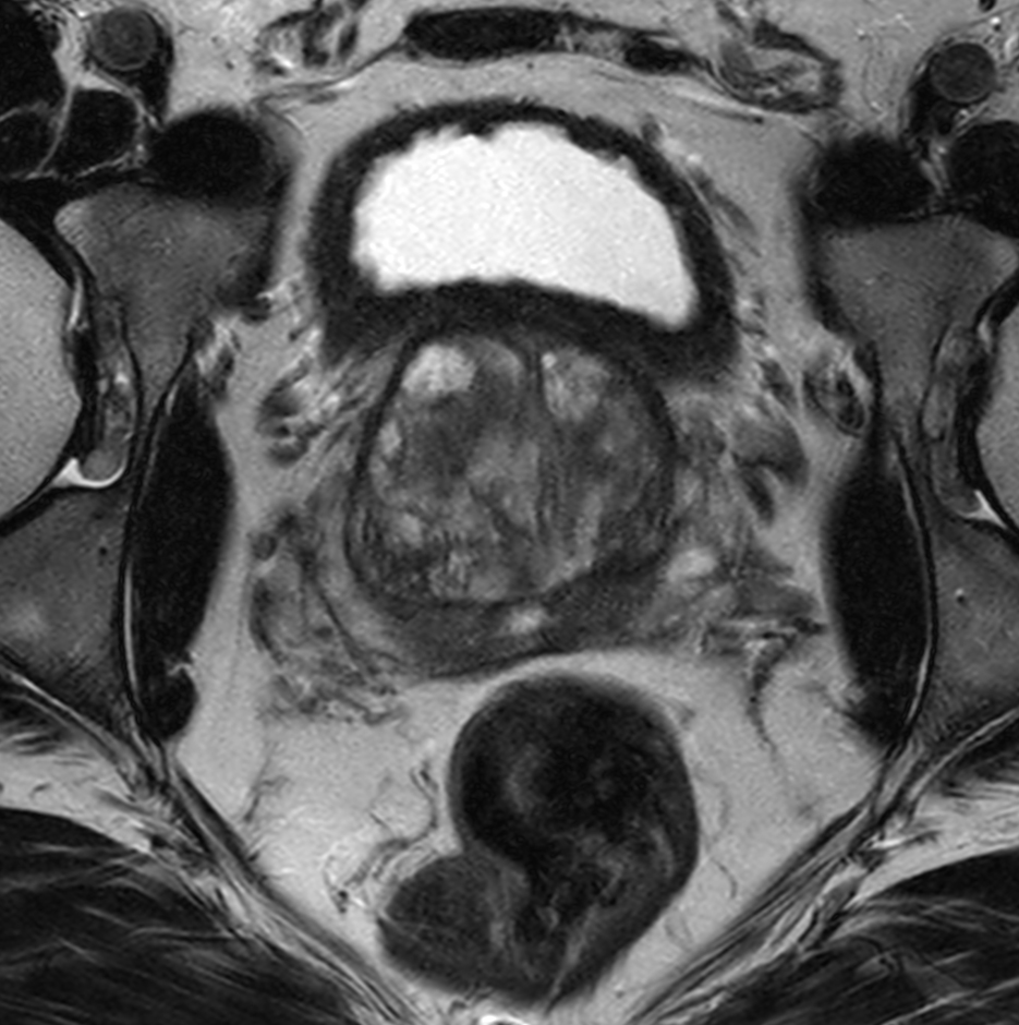 Axial T2w TSE with Compressed SENSE
