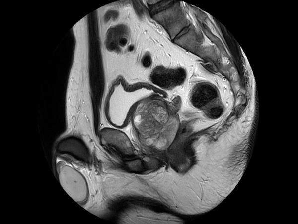 Sagittal T2w TSE - MultiVane XD