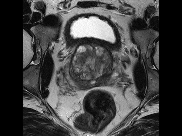 Axial T2w TSE with Compressed SENSE