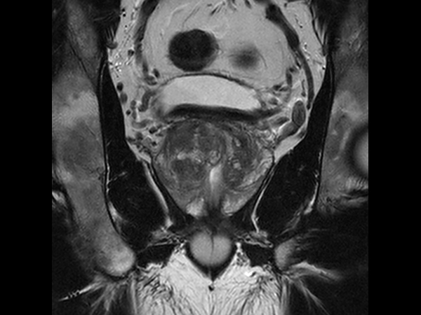 Coronal T2w TSE with Compressed SENSE