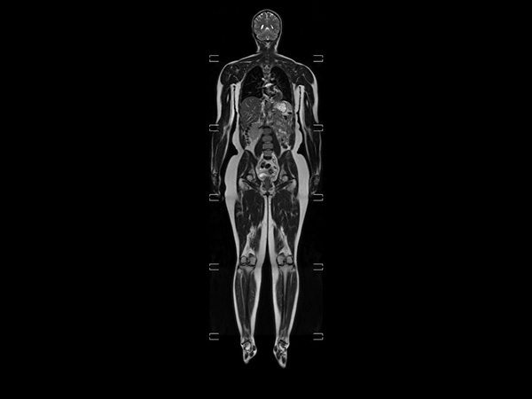 Coronal T2w TSE with Compressed SENSE