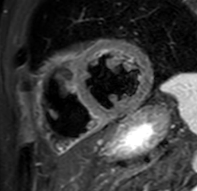 T2w STIR Black Blood <b>With Compressed SENSE: 9.6 sec breath hold</b>