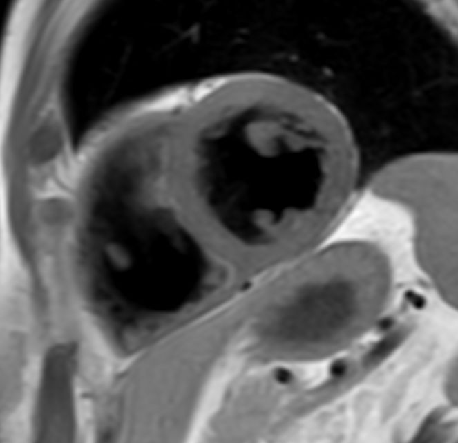 T1w TSE Black Blood <b>Without Compressed SENSE: 15.6 sec breath hold</b>