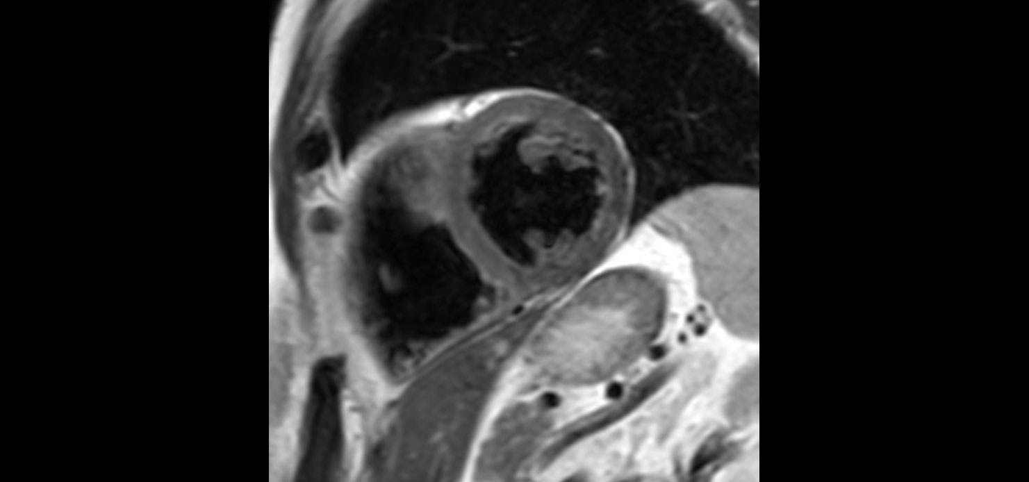 T2w TSE Black Blood <b>Without Compressed SENSE: 12 sec breath hold</b>