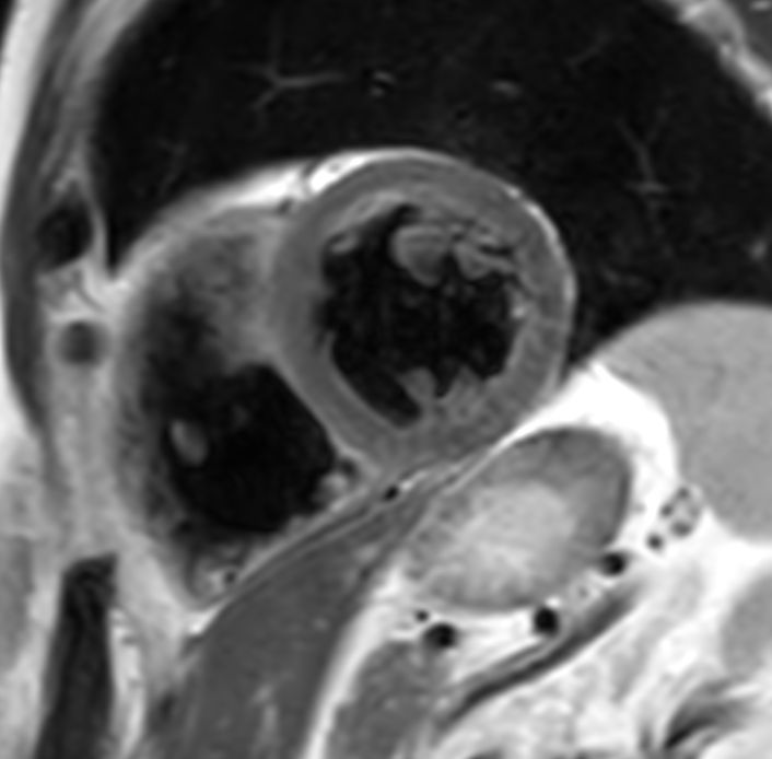 T2w TSE Black Blood <b>With Compressed SENSE: 9.6 sec breath hold</b>