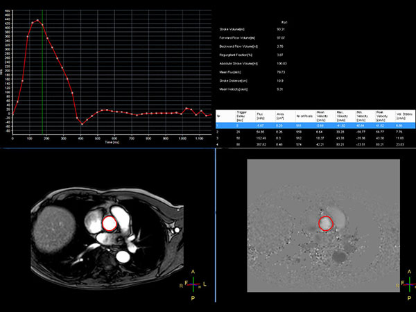 Qflow aorta