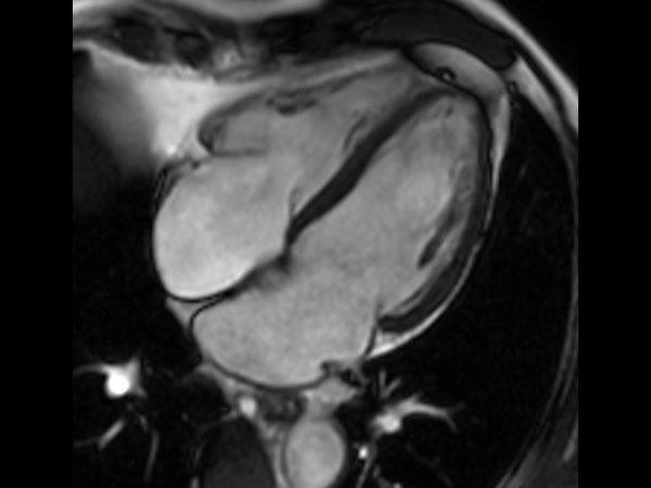 bTFE 4 chamber <b>Without Compressed SENSE: 7.2 sec breath hold</b>