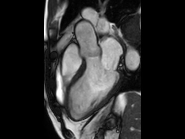 bTFE left ventricular outflow tract