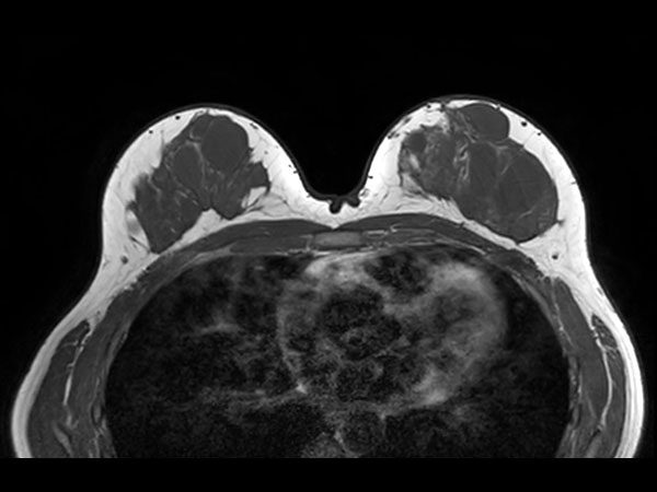 T2w TSE <b>Without Compressed SENSE: 2:42 min</b>