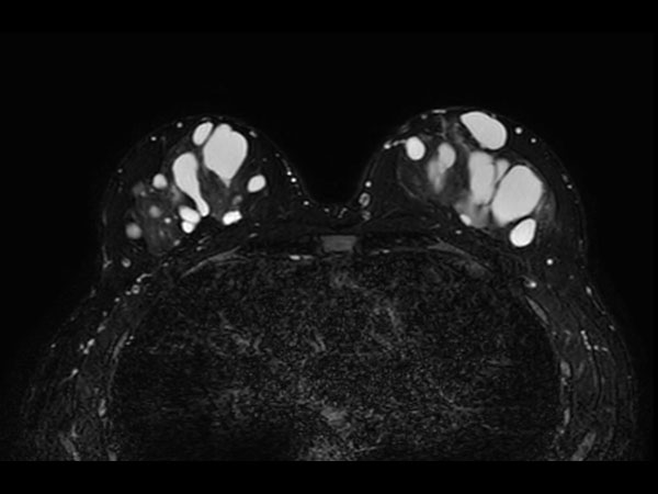 T2w TSE mDIXON (Water only) <b>With Compressed SENSE: 2:14 min</b>