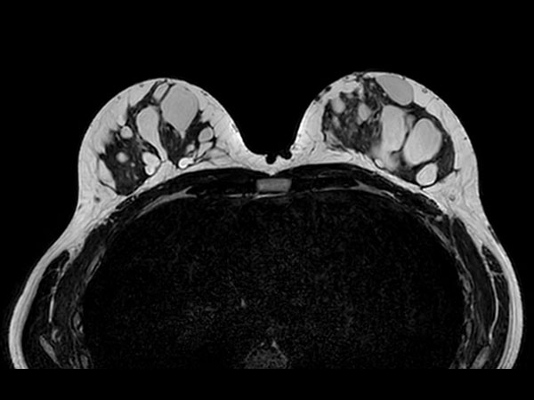 3D BreastVIEW T2w TSE <b>Without Compressed SENSE: 3:20 min</b>