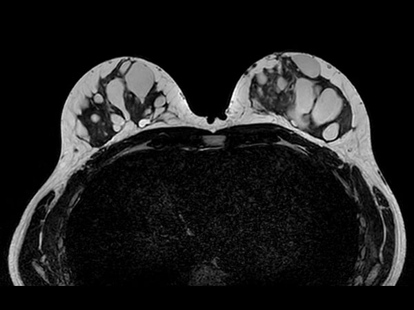 3D BreastVIEW T2w TSE <b>With Compressed SENSE: 1:26 min</b>