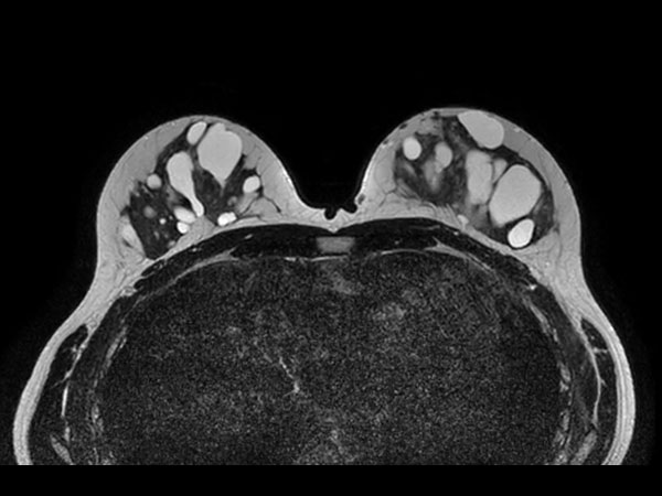 T2w TSE mDIXON (In Phase) <b>Without Compressed SENSE: 4:09 min</b>