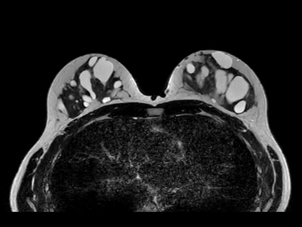 T2w TSE mDIXON (In Phase) <b>With Compressed SENSE: 2:14 min</b>