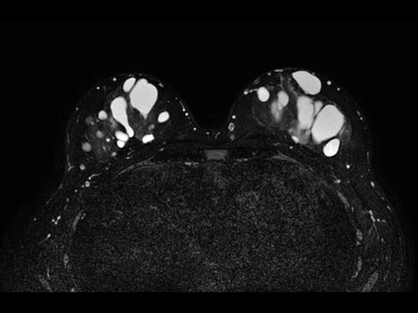 T2w TSE mDIXON (Water only) <b>Without Compressed SENSE: 4:09 min</b>