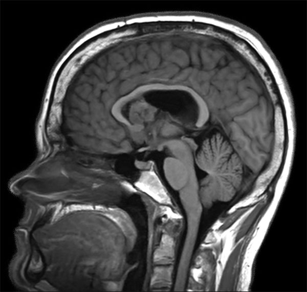 Sagittal T1W IR TSE