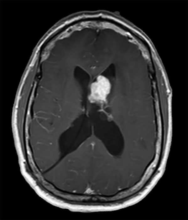 Axial T1W SE (with gado)