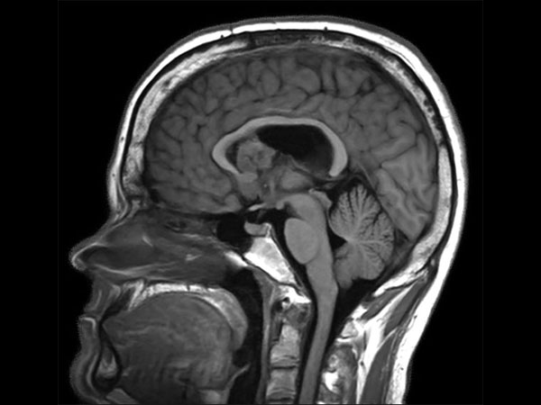 Sagittal T1W IR TSE