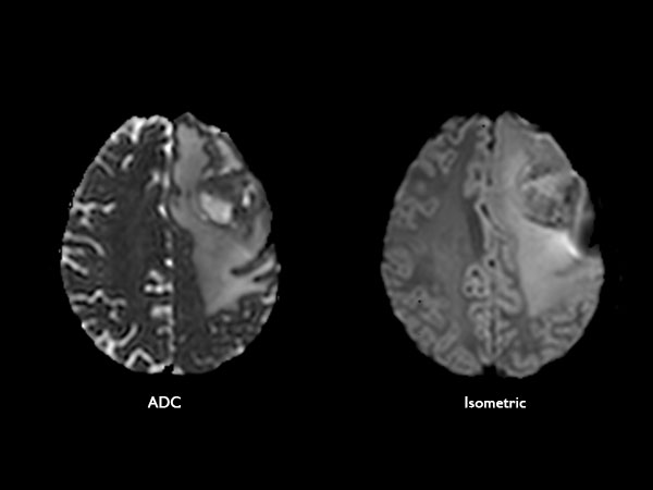 Axial Diffusion Tensor Imaging (15 directions)