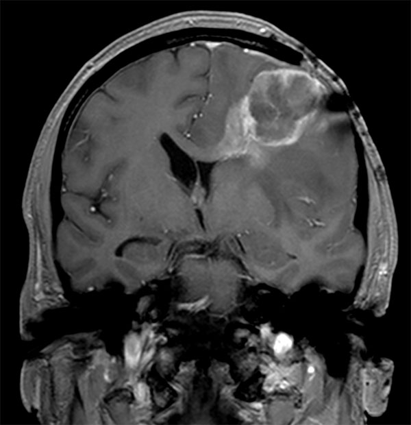 Coronal T1w FFE (post-gado)