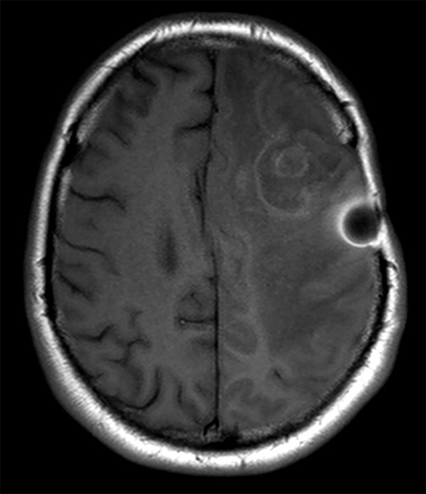 Axial T1w SE (post gado)