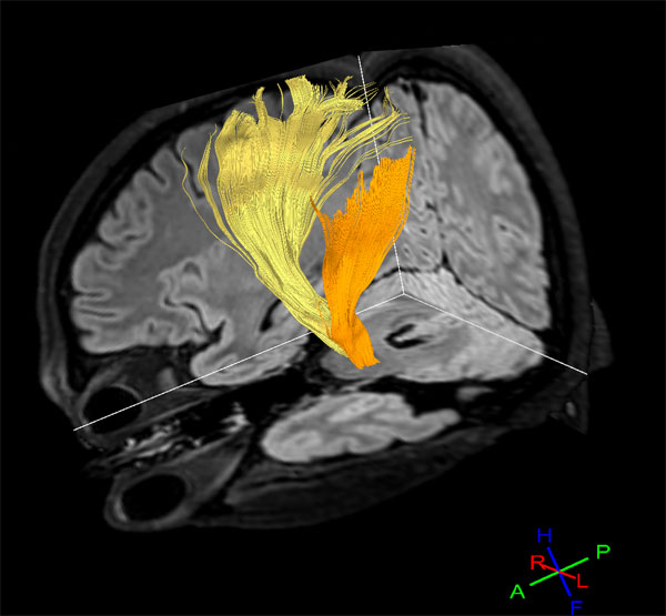 Diffusion Tensor Imaging - Fibertrak