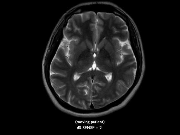 Axial T2w MultiVane XD