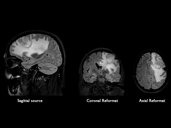 BrainView Flair