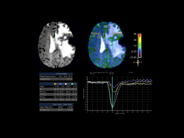 Axial T2* Perfusion