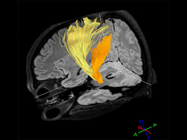 Diffusion Tensor Imaging - Fibertrak