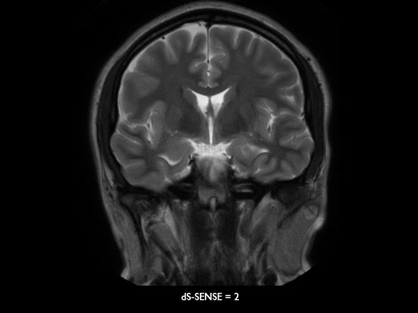 Coronal T2w MultiVane XD