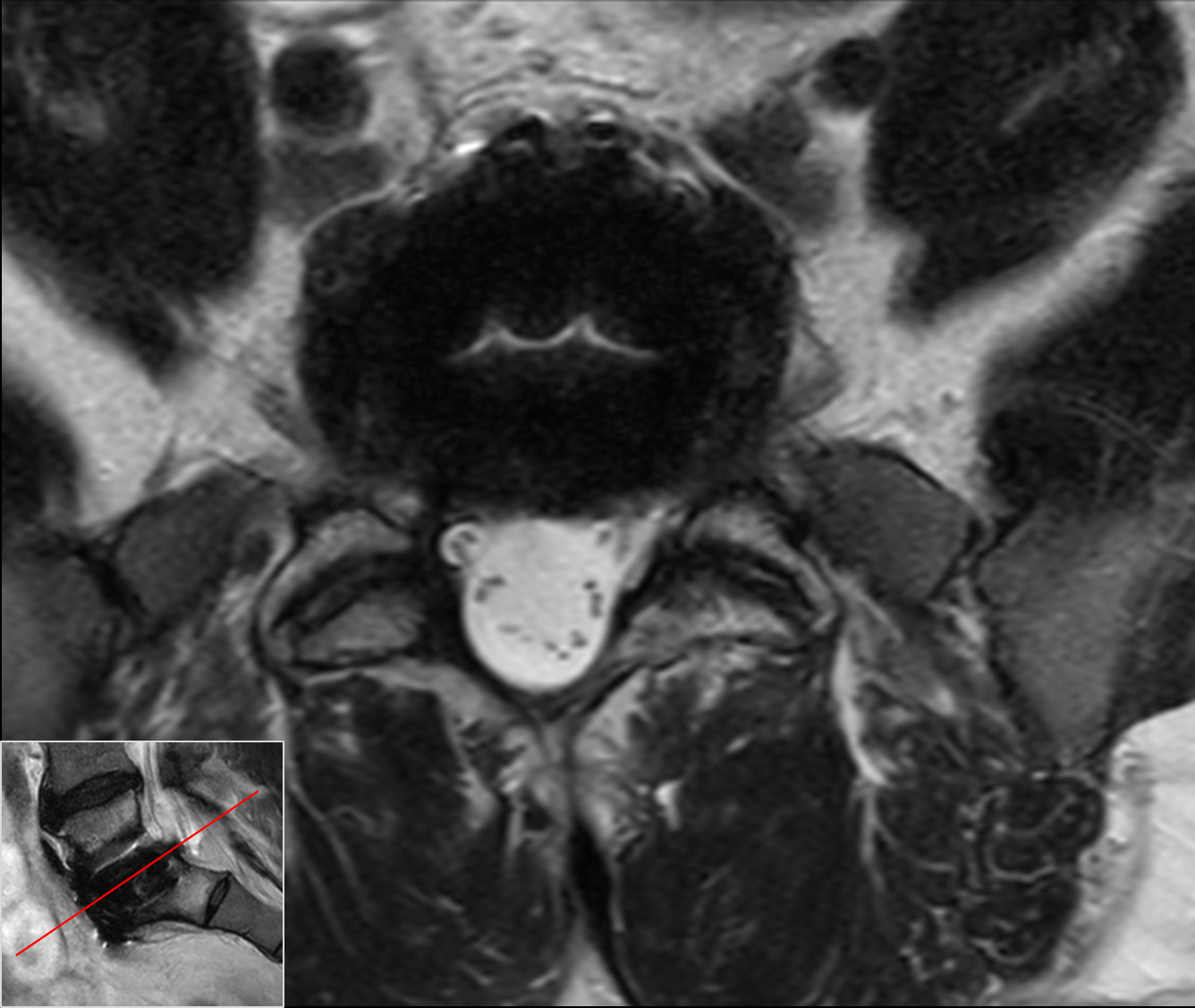 Axial T2w TSE<b>Compressed SENSE</b>