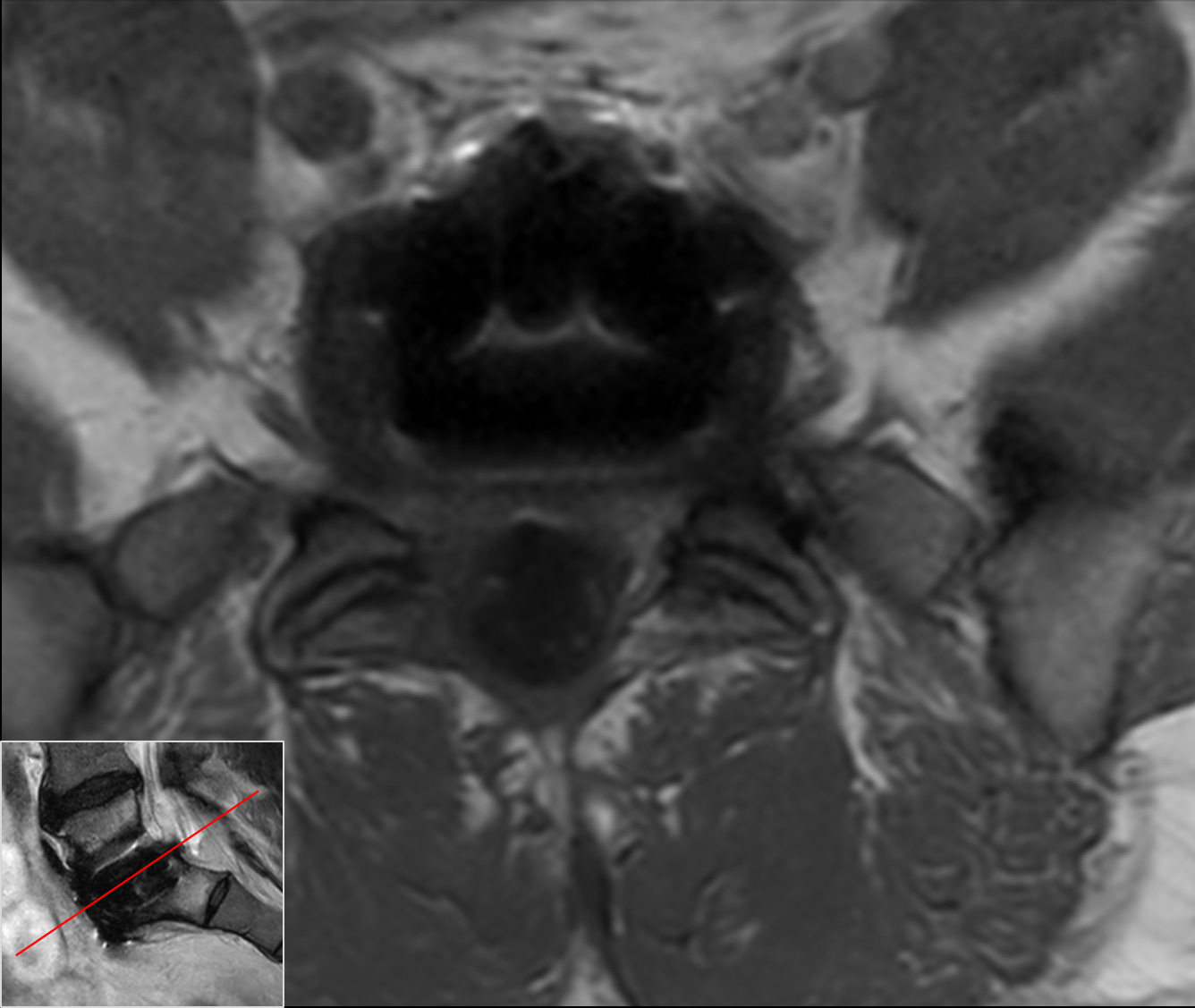 Axial T1w TSE<b>Compressed SENSE</b>