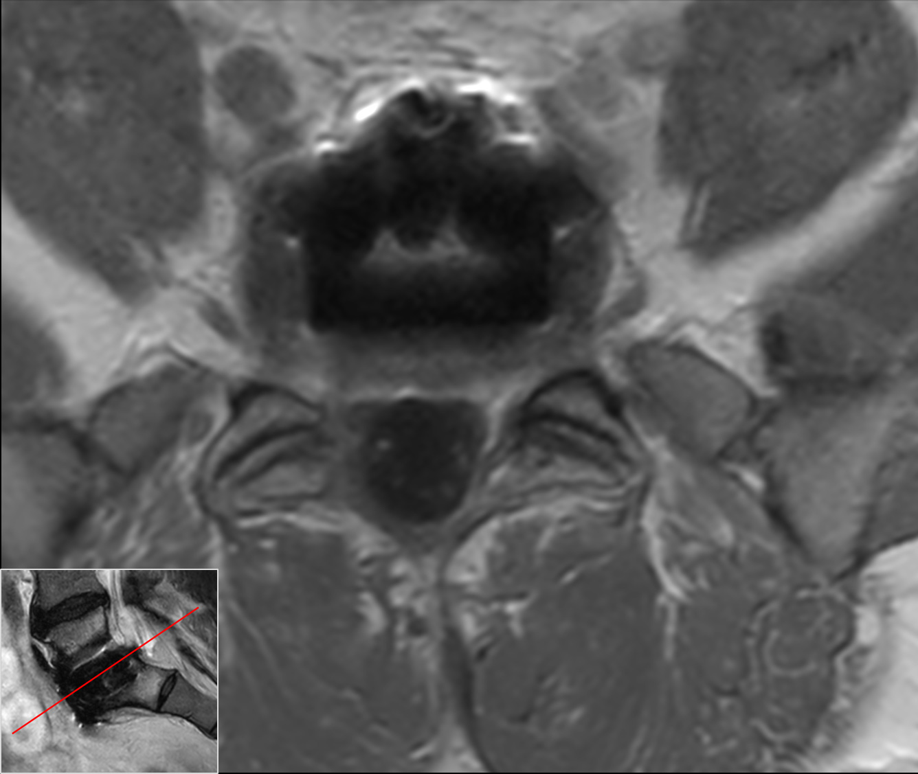 Axial T1w TSE, post-gado<b>Compressed SENSE</b>