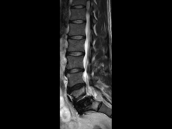 Sagittal T2w TSE<b>Compressed SENSE</b>