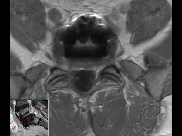 Axial T1w TSE, post-gado<b>Compressed SENSE</b>