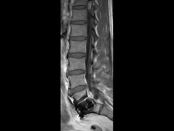 Sagittal T1w TSE, post gado<b>Compressed SENSE</b>