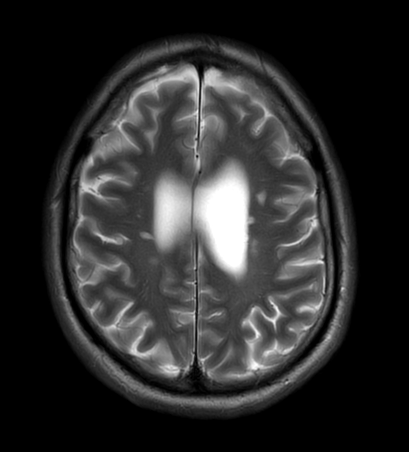 Axial T2w TSE MultiVane XD