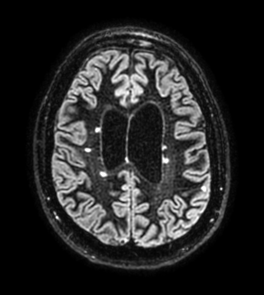3D BrainVIEW Double IR - Axial reformat