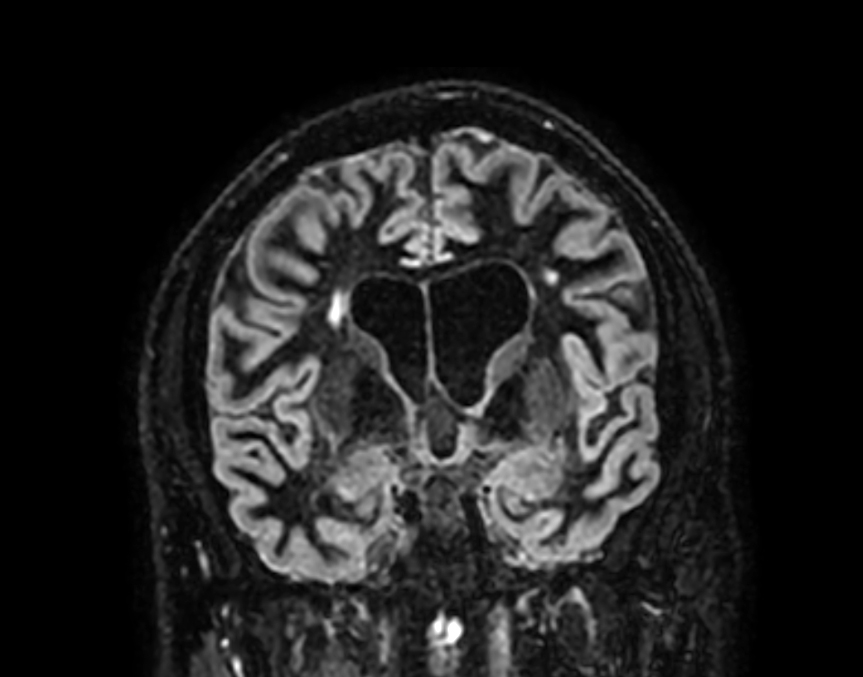 3D BrainVIEW Double IR - Coronal reformat